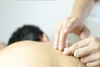 لاغری با طب سوزنی