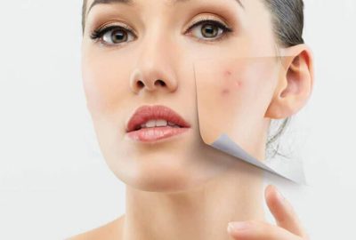 رابطه اکنه و فعالیت جنسی