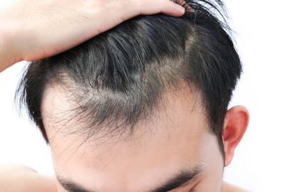 داروهای موثر برای مقابله با ریزش مو: راهنمایی برای بازیابی سلامت مو