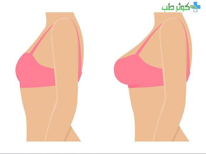 درمان خانگی برای درمان افتادگی سینه