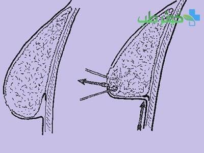 درمان افتادگی سینه و سفت کردن سینه با لیفت