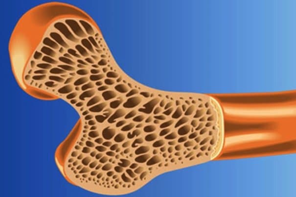 پوکی استخوان چیست و چگونه درمان می شود؟